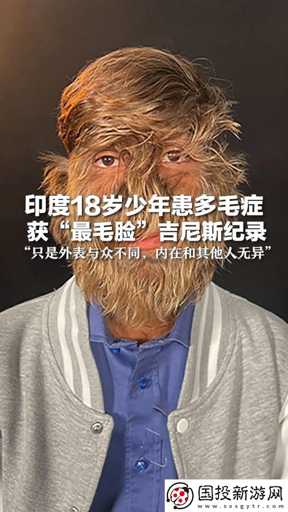 印度少年获“最毛脸”吉尼斯纪录